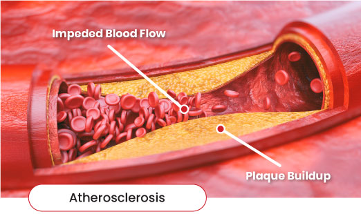 atherosclerosis