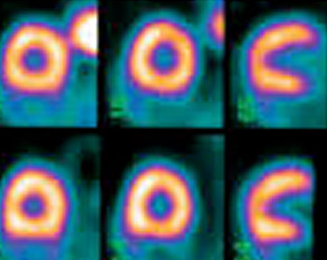 nuclear cardiology in tampa