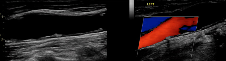 vascular ultrasound procedure in tampa